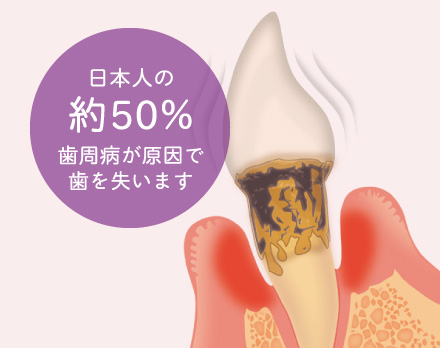 日本人の約50% 歯周病が原因で歯を失います