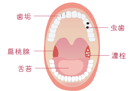 歯垢、虫歯、扁桃腺、濃栓、舌苔