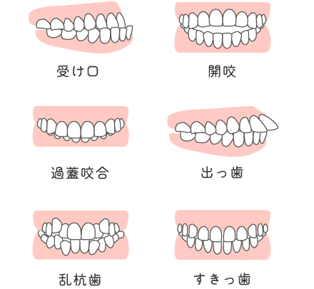 受け口、開咬、過蓋咬合、出っ歯、乱杭歯、すきっ歯